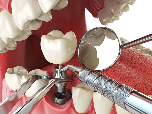 Best Emergency Treatment for Dental Infections or Abscesses in Summit, IL